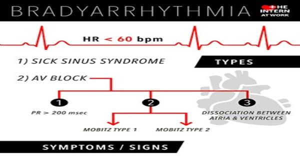 Bradyarrhythmias Infographic Infographics