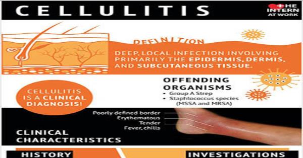 Cellulitis Infographic Infographics | Medicpresents.com