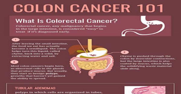 Colon Cancer 101 Infographic Infographics | Medicpresents.com