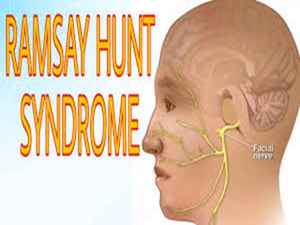 Unlocking The Mystery Of Ramsay Hunt Syndrome Causes Symptoms And