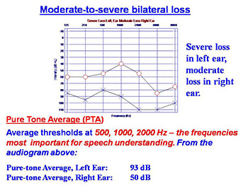 Hearing Disorders