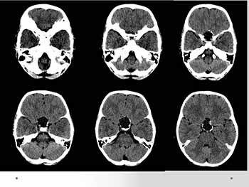 Neuro Radiology - Craniopharyngioma