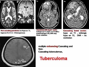 Clinical radiology of cerebral tuberculosis