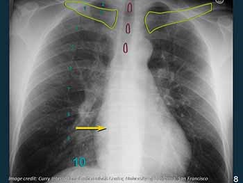 Basic Chest Radiology for the TB Clinician