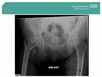 Hip Fracture