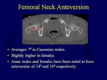 Hip Dislocations and Femoral Head Fractures