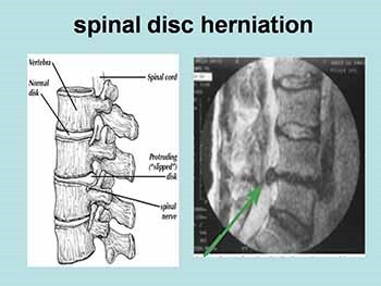 Disorders and Abnormal Curvatures of Spinal Column