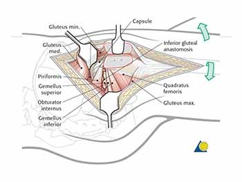 Femoroacetabular Impingement and Hip Arthroscopy