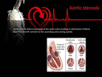 Aortic Stenosis