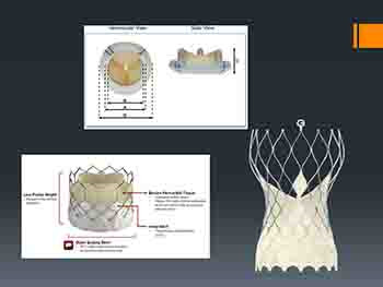 TAVR-Transcatheter Treatment of Aortic Stenosis Comes of Age