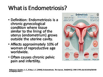 Understanding Endometriosis: Causes, Symptoms, and Treatments