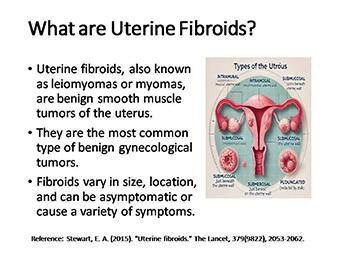 Comprehensive Guide to Uterine Fibroids: Symptoms, Diagnosis, and Treatment