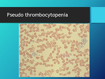 Bleeding disorders thrombocytopenia