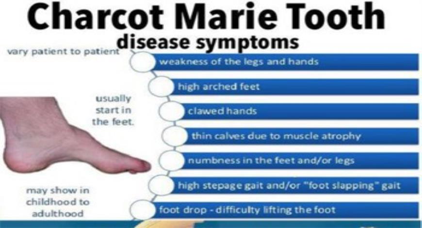 Download Medical Notes on Charcot Marie Tooth