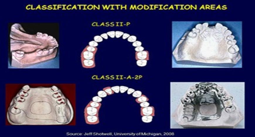 Download Free Medical Classification and Components of Removable 