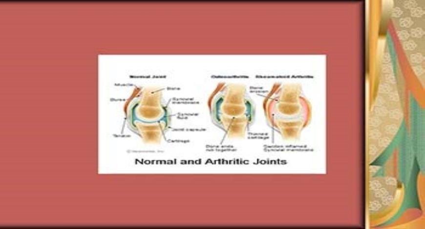 Download Free Medical Rheumatoid Arthritis An Autoimmune Mystery ...