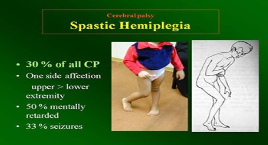 Download Free Medical Cerebral Palsy concepts and current views ...