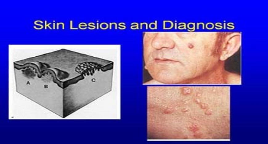 Download Free Medical Skin Lesions And Diagnosis Powerpoint Presentation