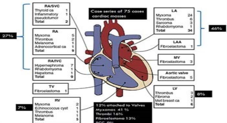 Download Free Medical Cardiac Tumors PowerPoint Presentation