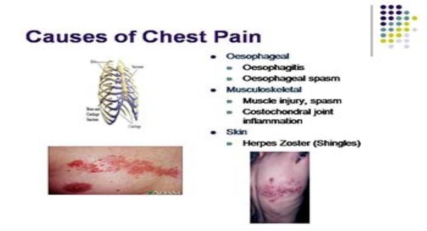 Reproducible Chest Pain