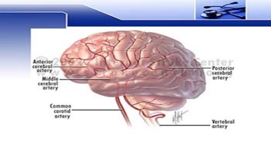 Download Free Medical Hemorrhagic stroke PowerPoint Presentation