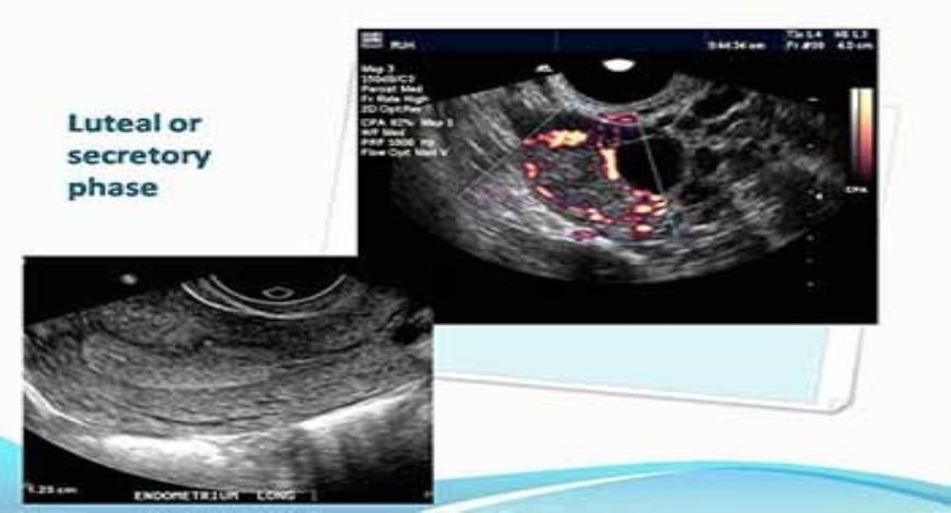 Download Free Medical Abnormal uterine bleeding PowerPoint Presentation