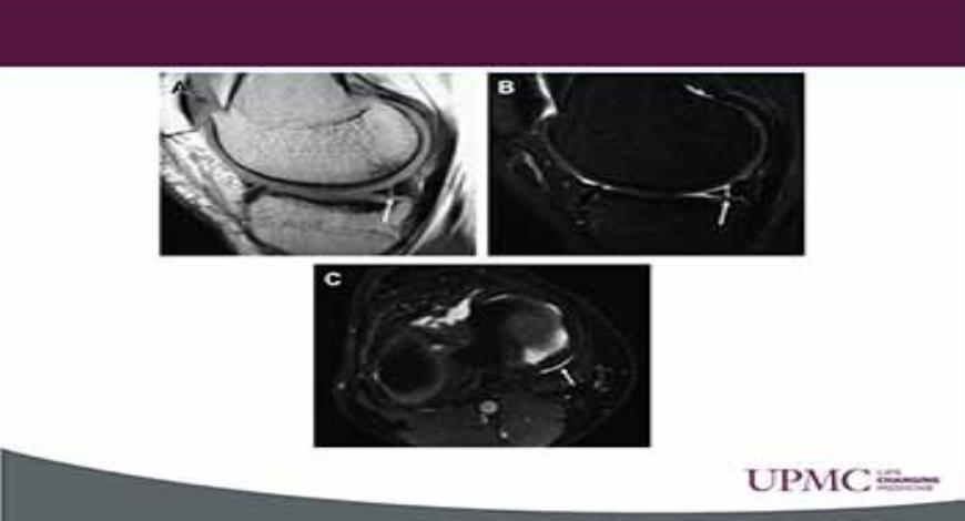 Download Free Medical Meniscus Injuries PowerPoint Presentation