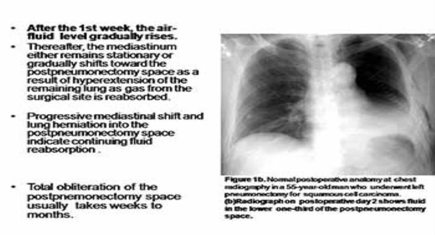 Download Free Medical Post Operative Chest Imaging PowerPoint Presentation