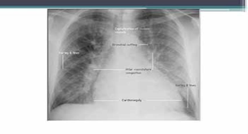 Download Free Medical Heart Failure in pediatrics PowerPoint Presentation