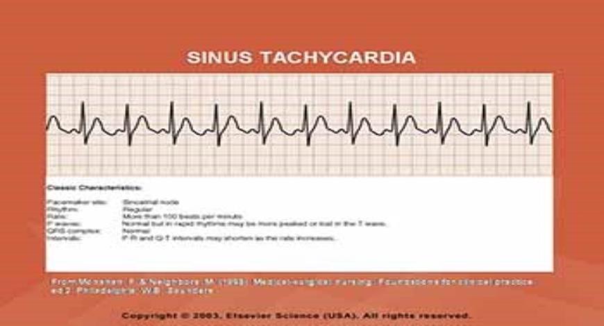 Download Free Medical CARDIAC DYSRHYTHMIAS PowerPoint Presentation