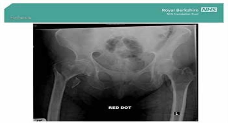 Download Free Medical Hip Fracture PowerPoint Presentation