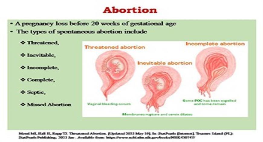 download-free-medical-threatened-abortion-powerpoint-presentation