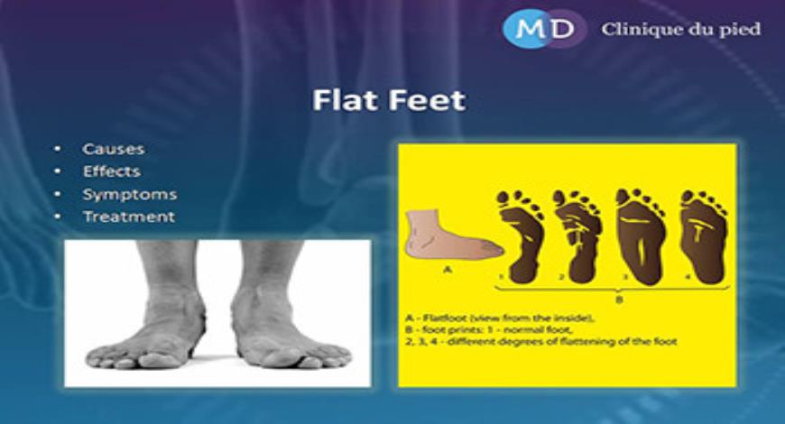 Download Free Medical Flat Feet-Causes Effects Symptoms and Treatment ...