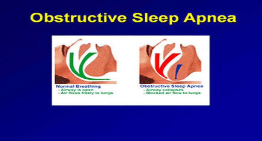 Download Free Medical Obstructive Sleep Apnea and Obesity ...