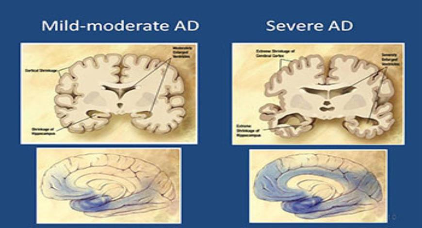 download-free-medical-seniors-with-memory-loss-powerpoint-presentation