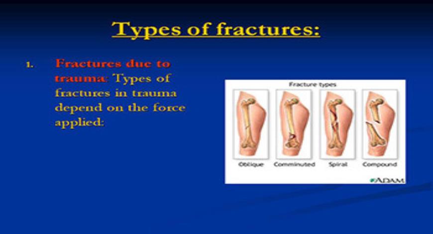 Download Free Medical Principles of Fractures PowerPoint Presentation