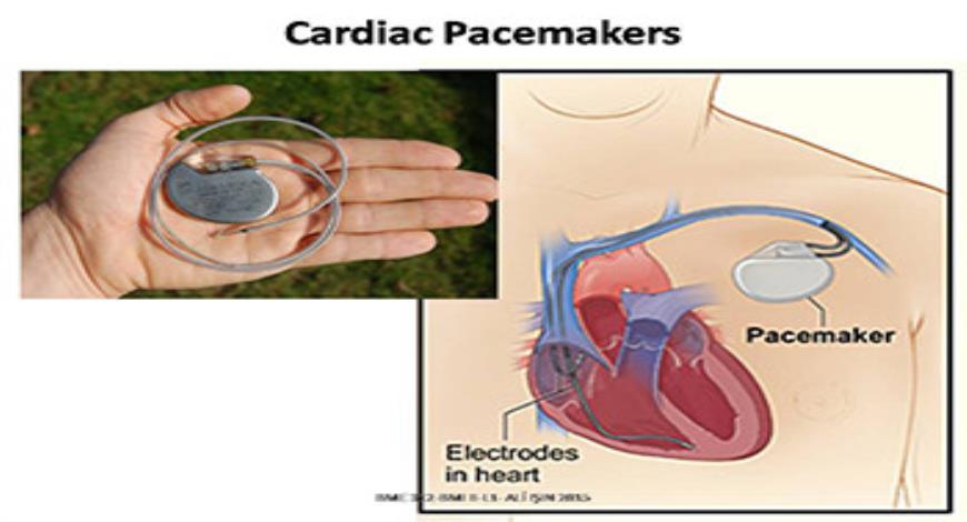 Download Free Medical Cardiac Pacemaker PowerPoint Presentation