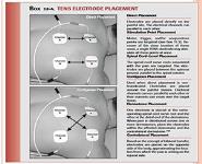 Transcutaneous Electrical Nerve Stimulation (TENS) PowerPoint Presentation