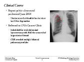 Uterine Leiomyosarcoma - A Case Presentation