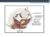 Submandibular gland: Surgical Anatomy Tumors Surgery