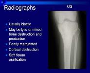 Bone and Soft Tissue Sarcomas PowerPoint Presentation