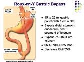 Complications and Benefits of Bariatric Surgery