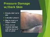 Pressure Ulcers Injuries Assessment and Treatment