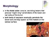 Colorectal Carcinoma