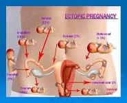 CLINICAL PRESENTATION OF A CASE PID TURNED OUT TO BE ECTOPIC PREGNANCY PowerPoint Presentation