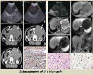 Radiological Imaging of Gastrointestinal tract Schwannoma PowerPoint Presentation