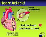 Automated External Defibrillators PowerPoint Presentation