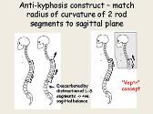 Kyphosis and Early-Onset Spine Deformity