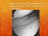 Approach to incomplete longitudinal meniscal tear