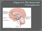 Schizophrenia